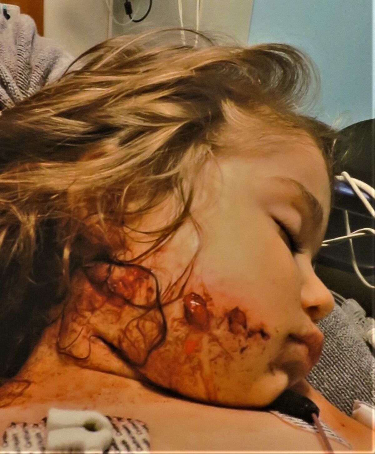 A photo showing a bloody wound to a young girl's face