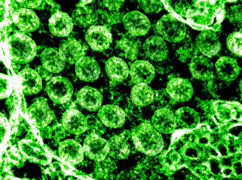 An electron micrograph shows particles of the coronavirus isolated from a patient.