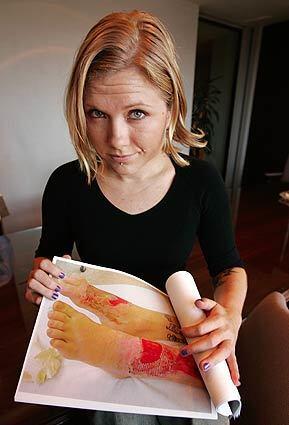 Gabriel Koloszar shows pictures of her injuries from a 2002 rollover accident in which she was a passenger in an SUV that was pulling a U-Haul trailer. Her feet required multiple surgeries and skin grafts. She and the Explorers driver sued U-Haul International, saying the accident was caused by a defective tire on the trailer they were towing. U-Haul blamed the wreck on driver errors. The judge said he would impose sanctions against U-Haul after the tire and rim disappeared from a company shop. Without admitting liability, U-Haul agreed last week to an undisclosed settlement.