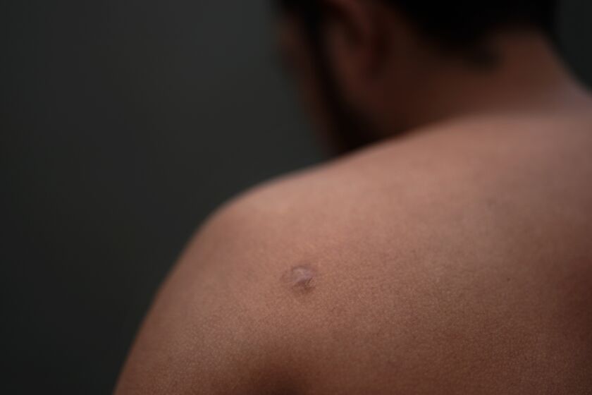 Asylum seeker Teodoso Vargas shows bullet wounds to his torso, after being shot nine times during a robbery in his native Honduras, Monday, May 22, 2023, as he waits to apply for asylum in the border city of Tijuana, Mexico. Asylum-seekers say joy over the end of the public health restriction known as Title 42 this month is turning into anguish with the realization of how the Biden administration's new rules affect them. Though the government opened some new avenues for immigration, many people's fate is largely left up to a U.S. government app that is limited and unable to decipher and prioritize human suffering and personal risk. (AP Photo/Gregory Bull)