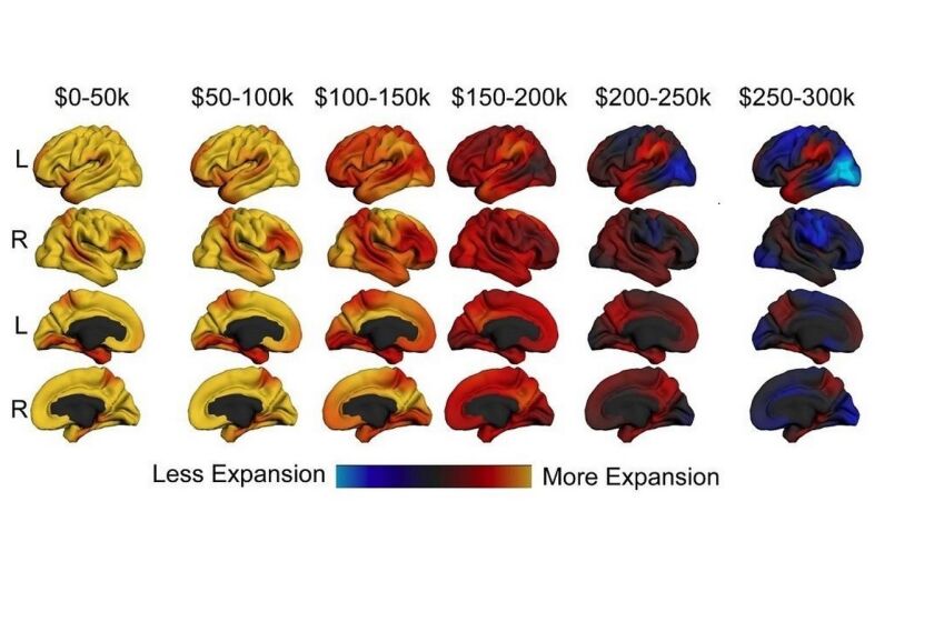 A study suggests that income correlates with an expanding brain, and small changes can have bigger effects at the lower end of the income scale.