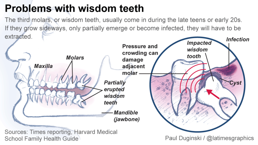 Melbourne Wisdom Teeth