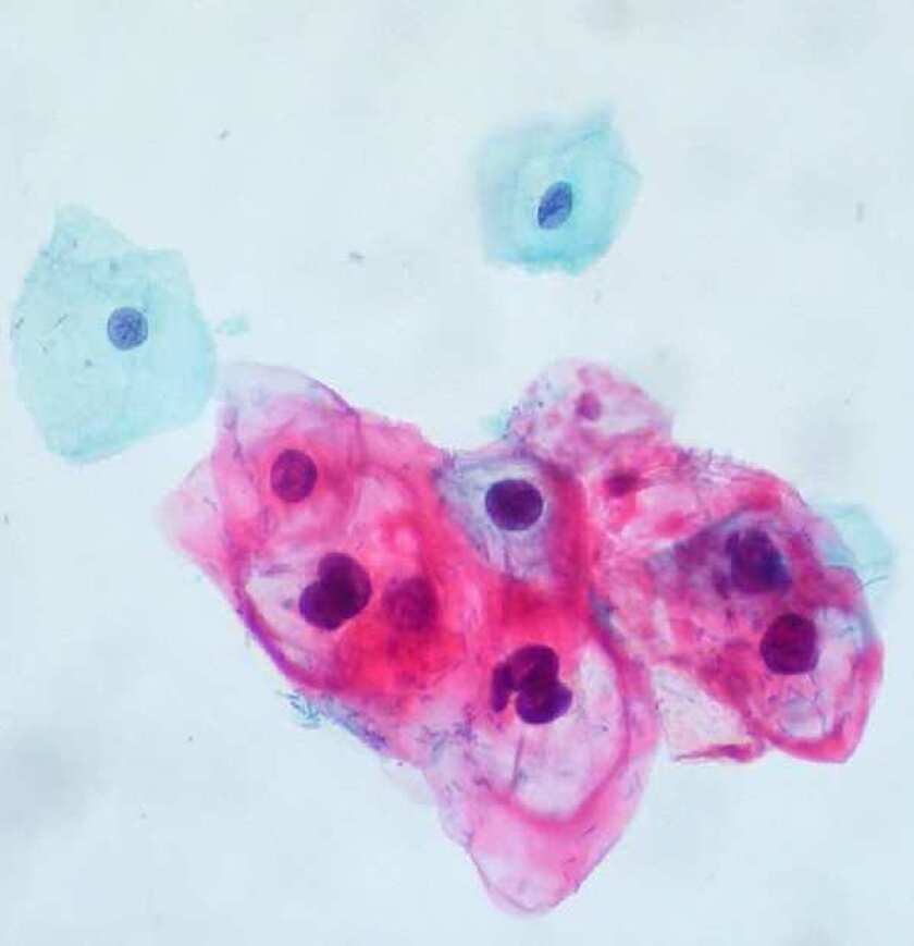 Cervical cells infected with HPV.