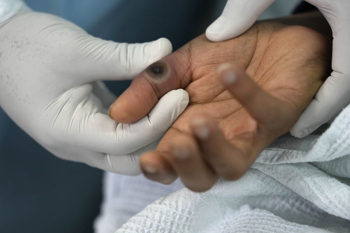 Un médico muestra una llaga en la mano de un paciente causada por la viruela símica en el hospital Arzobispo Loayza en Lima, Perú, el martes 16 de agosto de 2022. (Foto AP/Martín Mejía)
