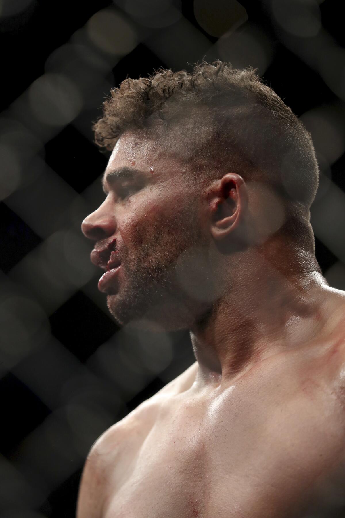 Alistair Overeem is seen with a cut lip after losing to Jairzinho Rozenstruik.