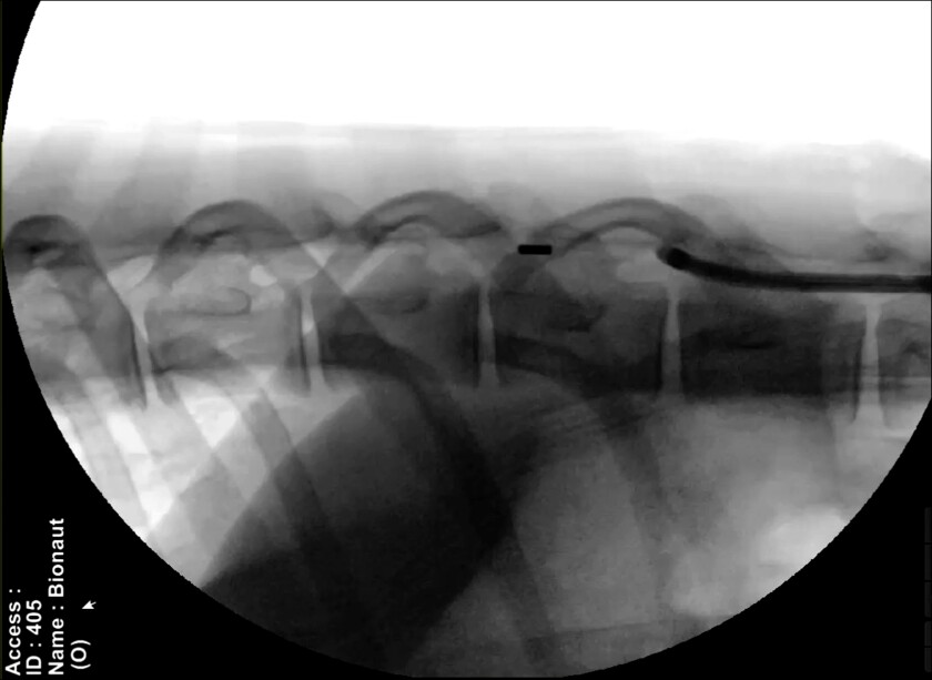 Bionaut device moving from a catheter into the subarachnoid space in a live sheep spine. Year 2020.