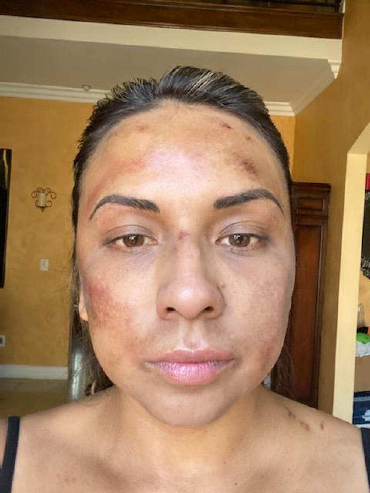 A woman with bruises and abrasions on her face 