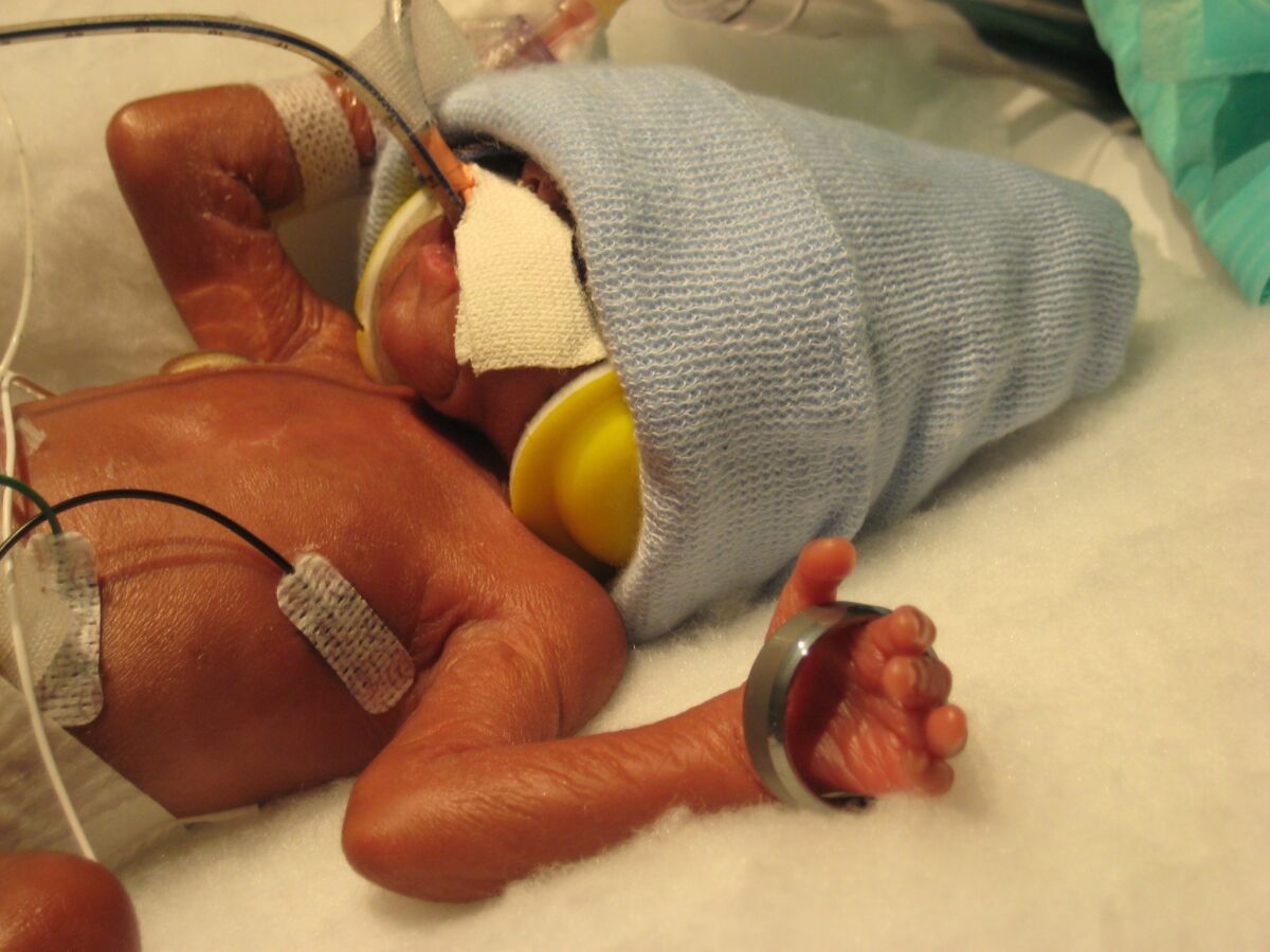 Baby Adris' hands were so tiny when he was born prematurely that one hand fit inside his parents' wedding band.