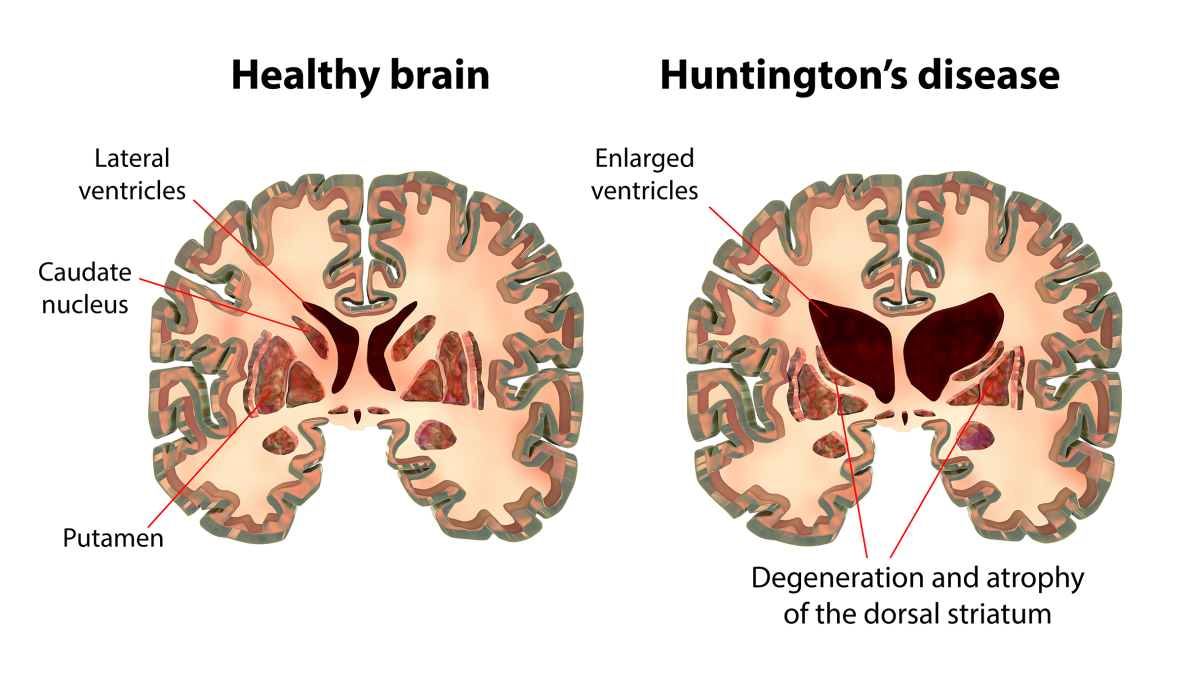 Coronal sections of a healthy brain and a brain in Huntington's disease.