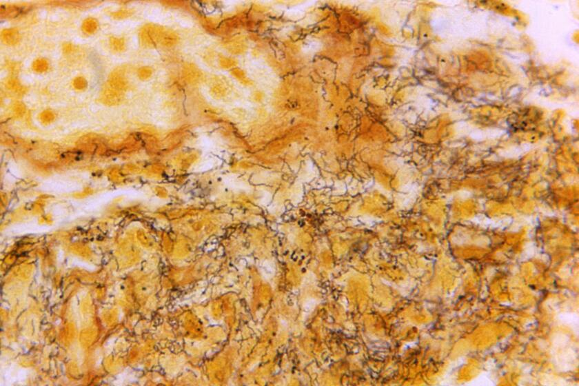 FILE - This 1966 microscope photo made available by the Centers for Disease Control and Prevention shows a tissue sample with the presence of numerous, corkscrew-shaped, darkly-stained, Treponema pallidum spirochetes, the bacterium responsible for causing syphilis. The U.S. syphilis epidemic continues to worsen, according to a new government report released Tuesday, Jan. 30, 2024, that also contains some unexpected good news — the rate of new gonorrhea cases has fallen for the first time in a decade. (Skip Van Orden/CDC via AP, File)