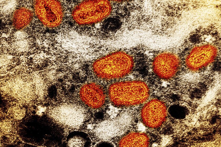This iamge provided by the National Institute of Allergy and Infectious Diseases (NIAID) shows a colorized transmission electron micrograph of monkeypox particles (orange) found within an infected cell (brown), cultured in the laboratory. This image was captured at the NIAID Integrated Research Facility (IRF) in Fort Detrick, Md. The World Health Organization recently declared the expanding monkeypox outbreak a global emergency. It is WHO’s highest level of alert, but the designation does not necessarily mean a disease is particularly transmissible or lethal. (NIAID via AP)