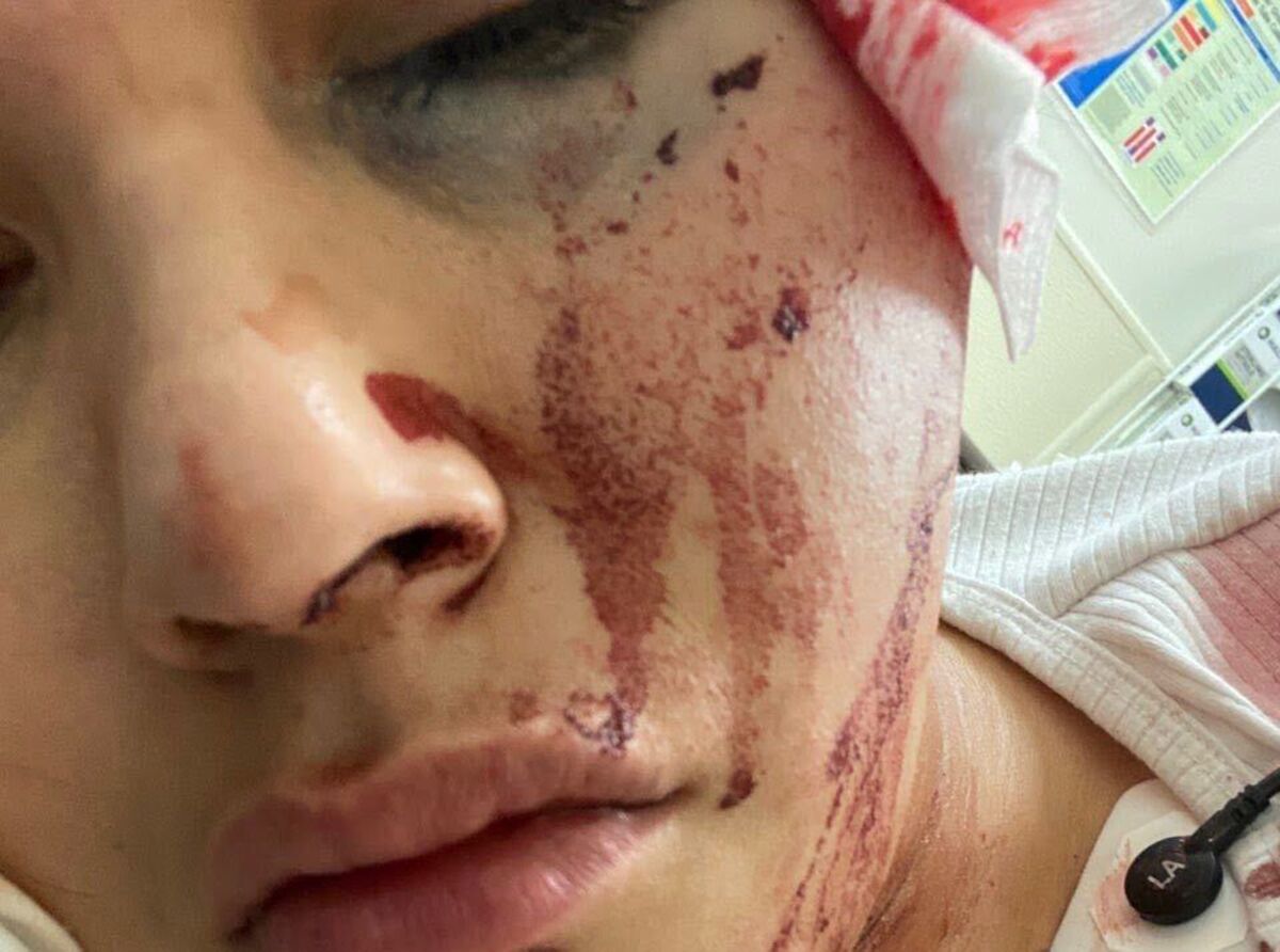 Jasmine Morales's face is bruised and bloody; she says she was struck by an LAPD foam bullet.