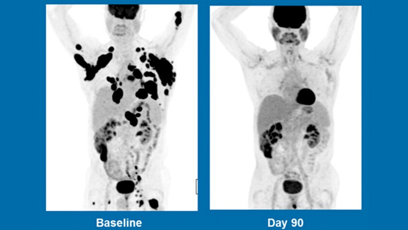 Body scans of a 62-year-old man with non-Hodgkin's lymphoma in December 2015, left, and three months after treatment with Kite Pharma's experimental CAR-T gene therapy, right.