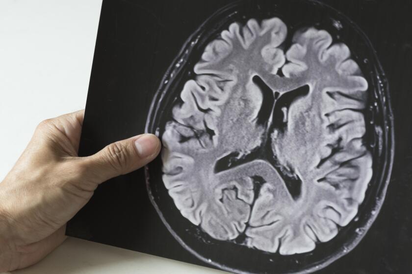A man holding human brain MRI picture