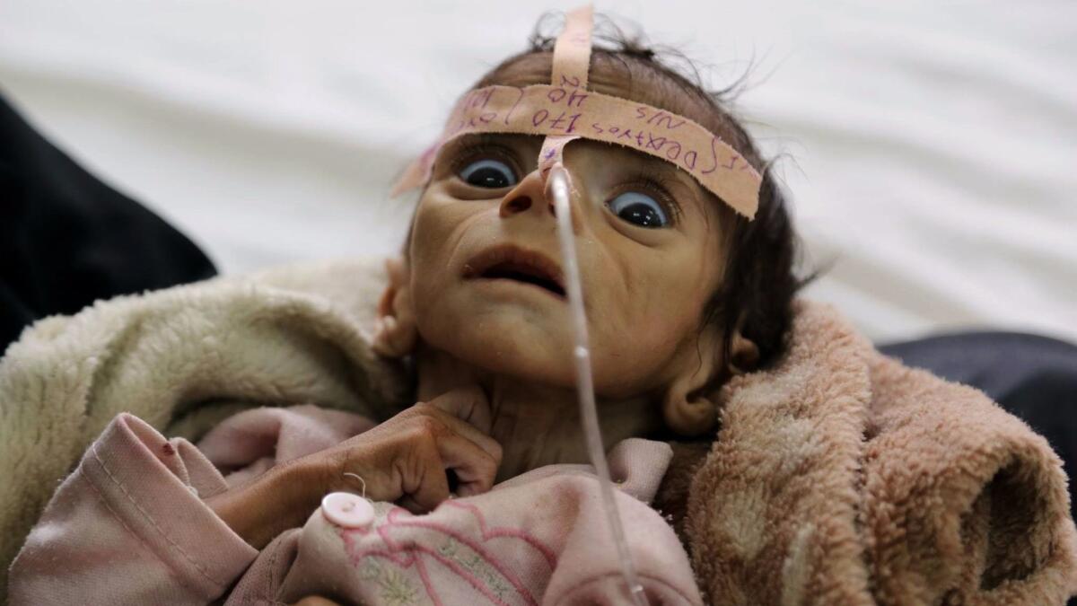 Udai Faisal, an infant suffering from acute malnutrition, is shown two days before his death on March 24, 2016, in Sana, Yemen. Millions face starvation and cholera in Yemen, where frequent bombing prevents aid from being delivered.