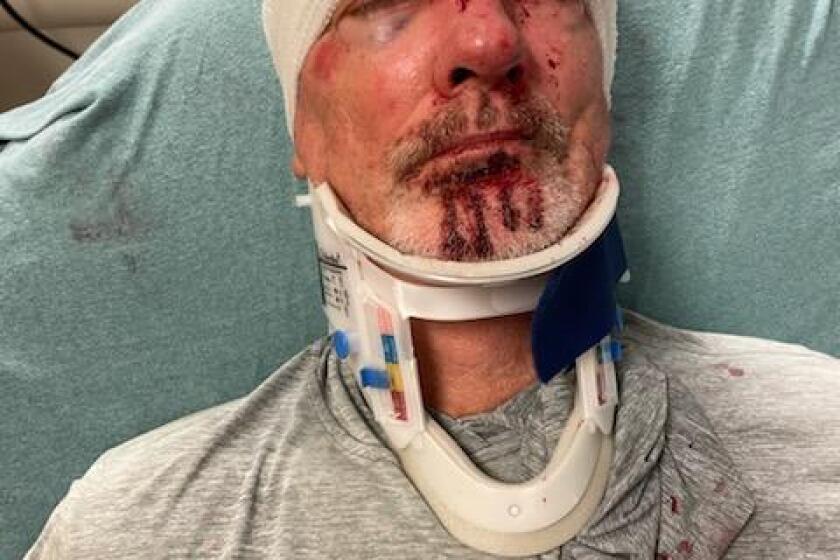 Todd Miller, a retired periodontist from Corona del Mar, said he doesn't recall anything leading up to the incident on Monday. Miller, pictured here immediately after his injuries, returned home Wednesday.