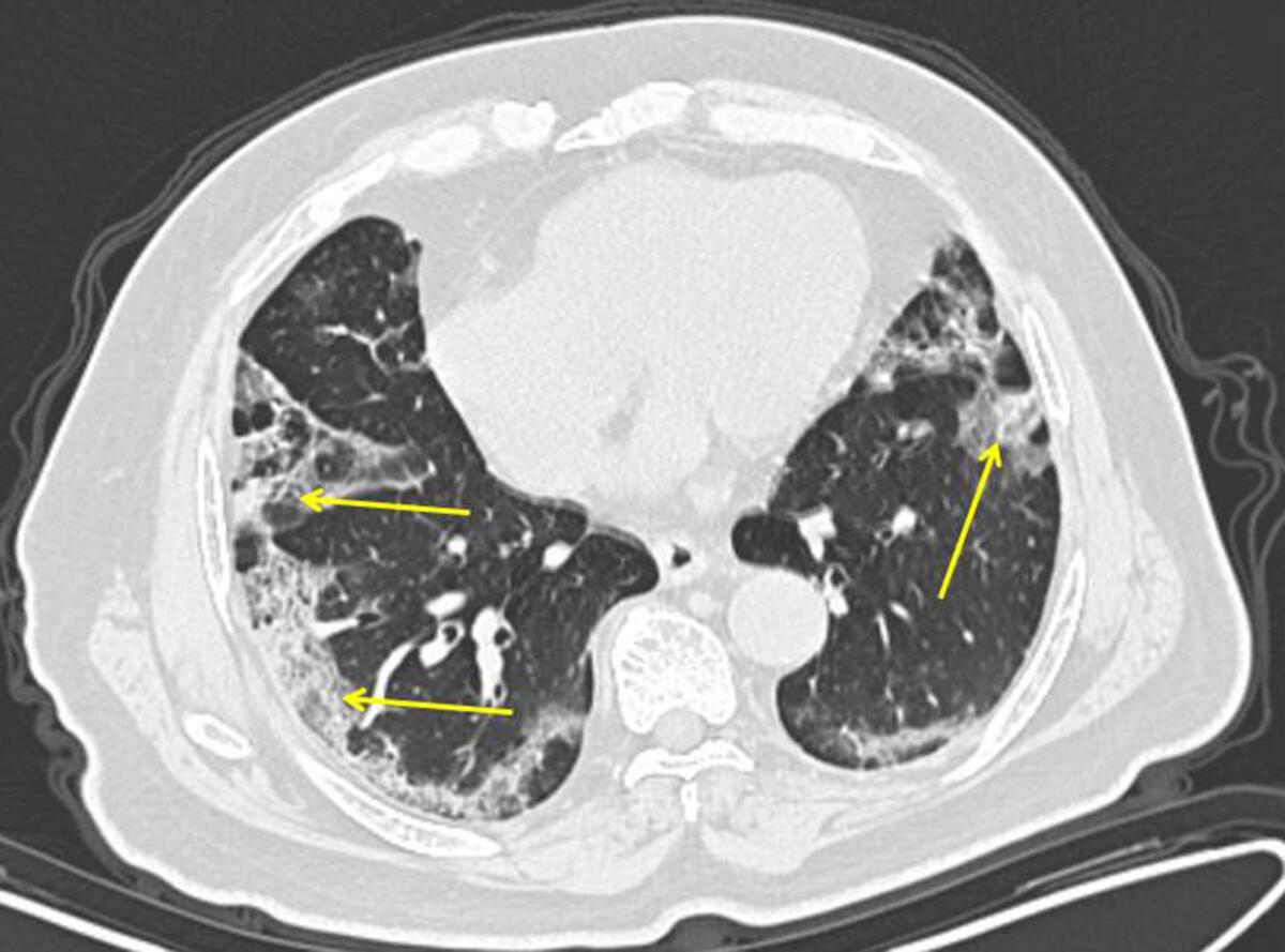 Shown is a CT scan from a 65-year-old man in China with COVID-19.