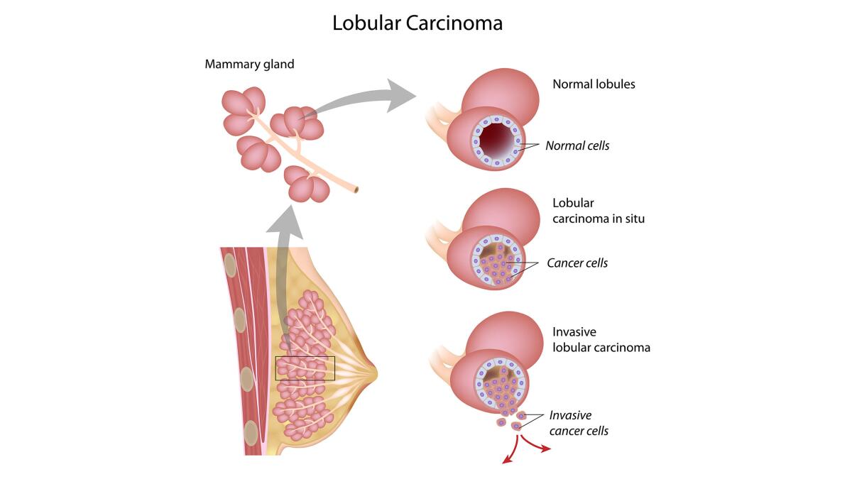 An illustration of lobular carcinoma breast cancer against a white background, showing different states.