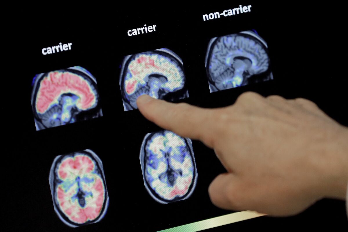 A doctor examines a PET brain scan of a patient with Alzheimer's disease. 