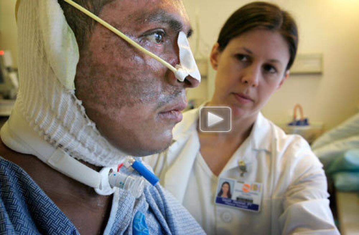 Physical therapist Sarah Hershel works with Harris fire victim Nicolas Beltran in the burn center at UC San Diego Medical Center. He had recently awakened from a two-month induced coma while surgeons repaired third-degree burns over 40% of his body. Watch video >>>