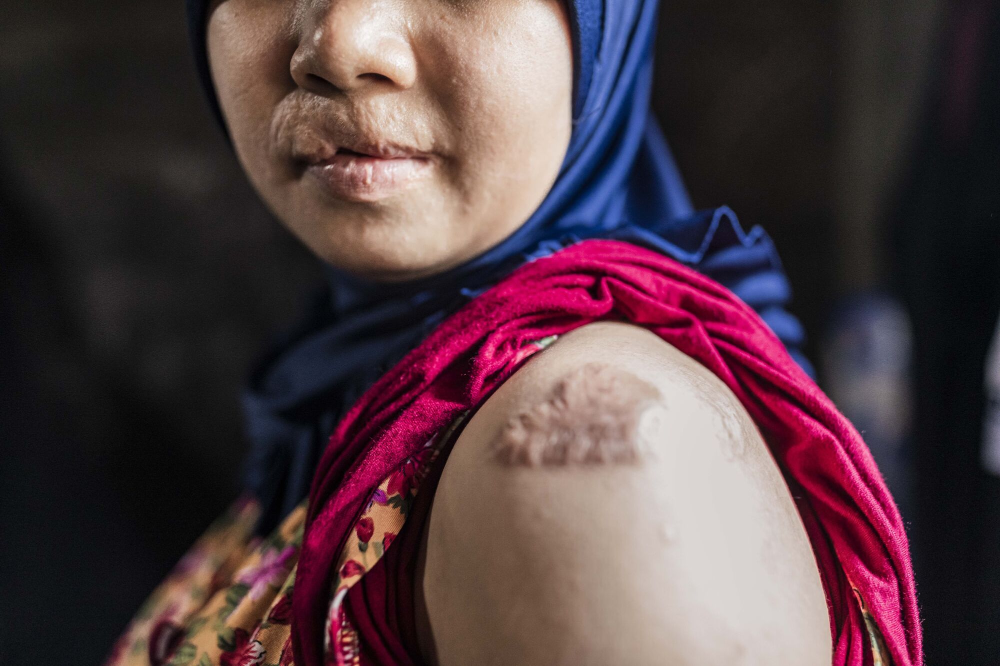 A woman bears marks of abuse on her lips and upper arm  
