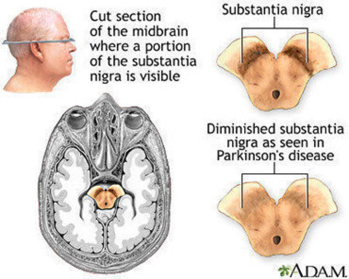 The accumulation of a protein called alpha-synuclein in Parkinson's disease causes the death of brain cells, particularly in the substantia nigra.