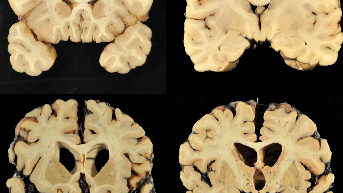 Photos provided by Boston University show sections from a normal brain, top, and from the brain of former University of Texas football player Greg Ploetz, bottom, in stage IV of chronic traumatic encephalopathy (CTE).