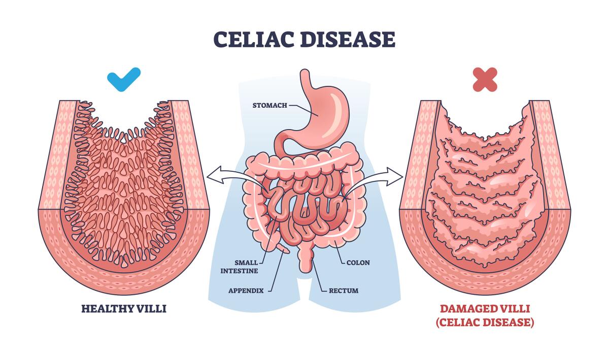 celiac disease and glp 1 Coeliac its Many Complications Tirzepatide and Celiac Disease: Safety