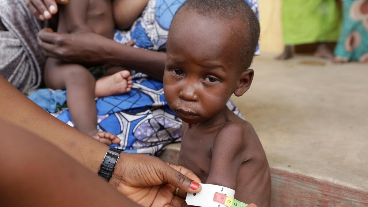A doctor attends to a malnourished child at a refugee camp in Yola, Nigeria, in May 2015.