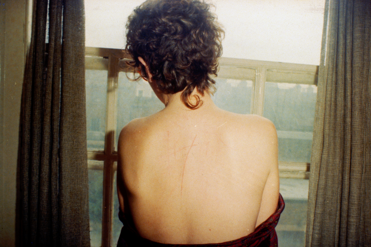 A photograph of a woman's bare scratched back