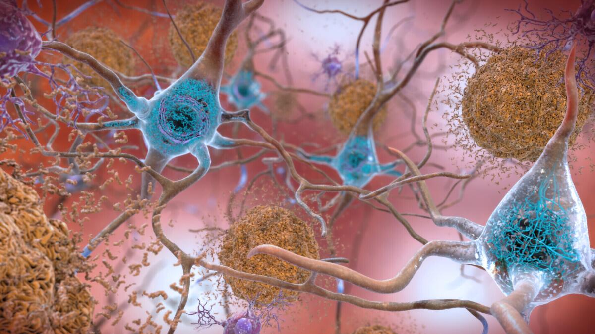 An illustration depicting neurons in a brain affected by Alzheimer's disease.