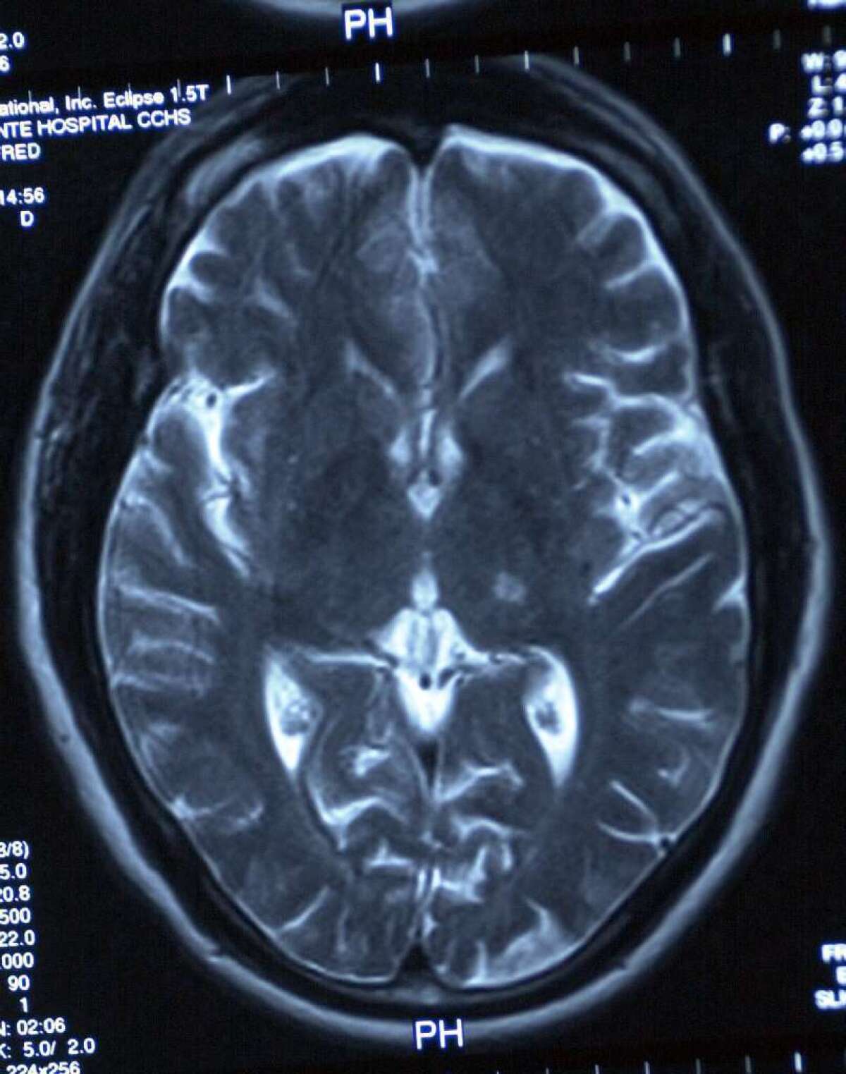 MR scan of a stroke victim's brain. New research reveals that 1 in 4 victims also suffers from PTSD.