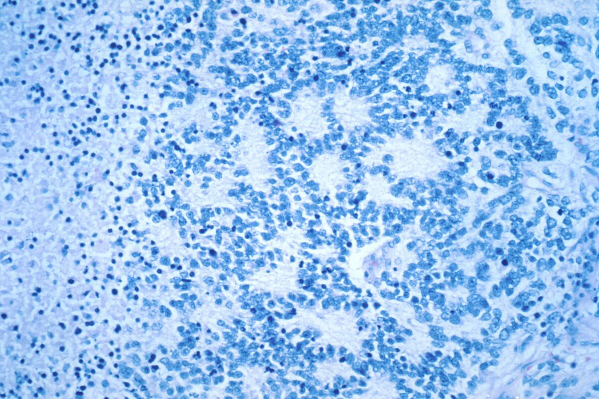 A typical neuroblastoma tumor is seen under a microscope. 