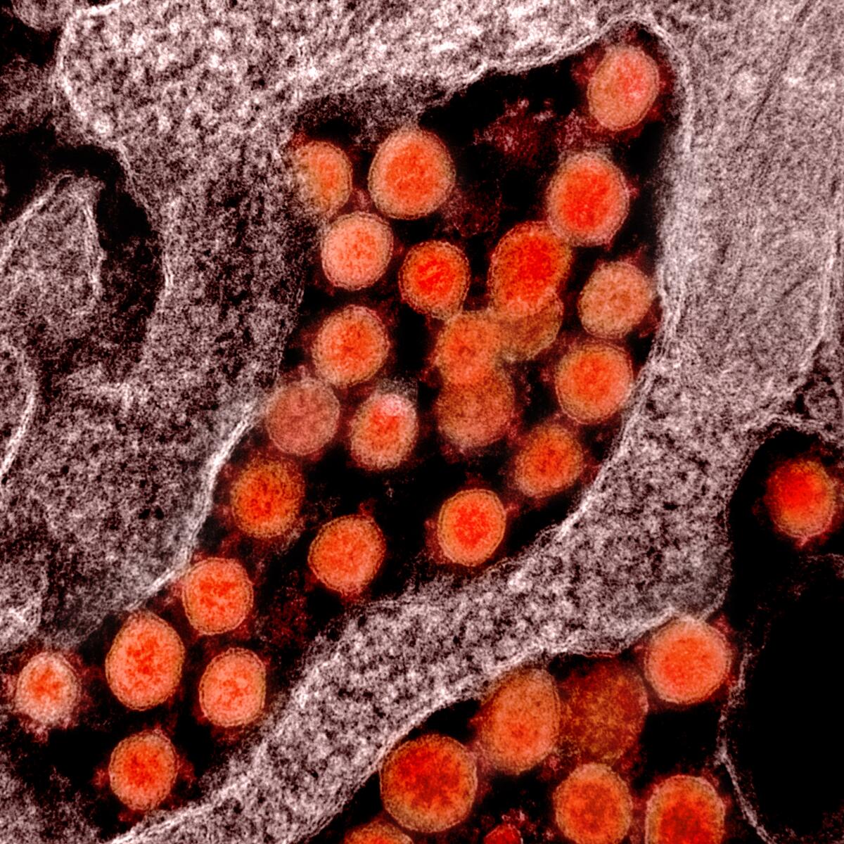 Transmission electron micrograph of new coronavirus particles, isolated from a patient.