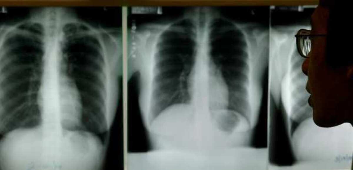 A doctor in Los Angeles studies chest X-rays for evidence of tuberculosis. A Modesto student has been diagnosed with the disease.