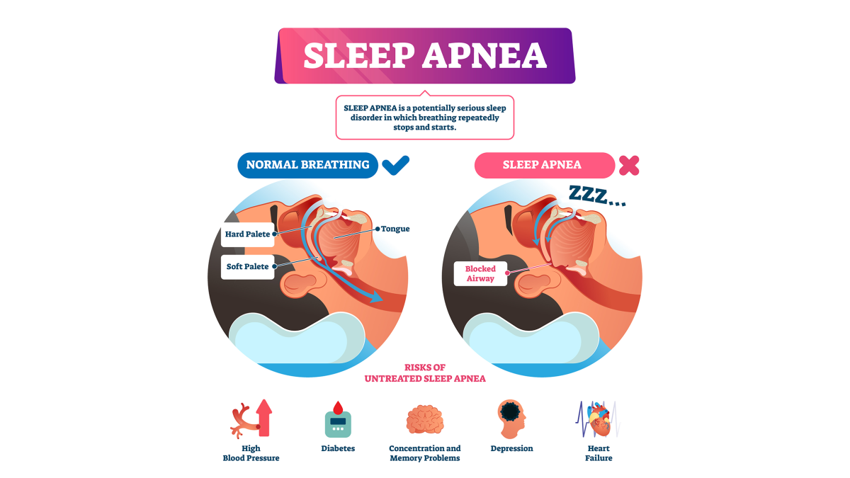 Sleep apnea vector illustration. Labeled nasal tongue blocked airway scheme and explanation of causes and diagnosis.