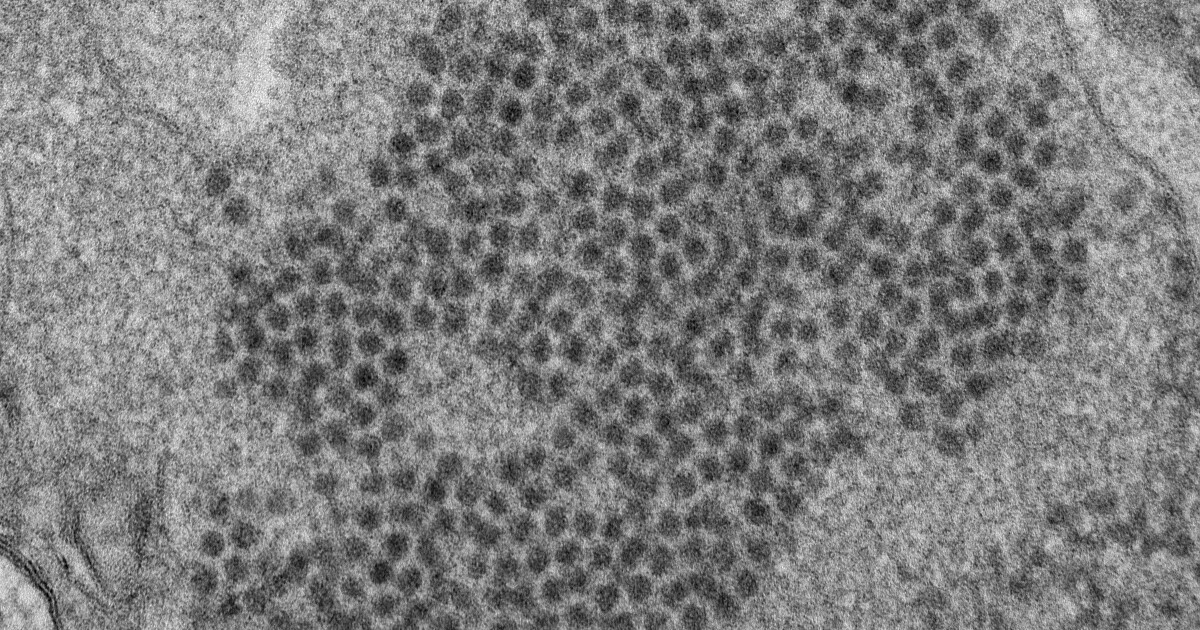 Virus may be culprit in AFM, the paralyzing, poliolike illness affecting kids
