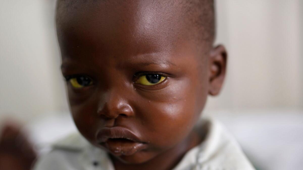 Three-year-old Jonathan Kangu sits on his hospital bed in Kinshasa, Congo. He is suffering from symptoms of yellow fever