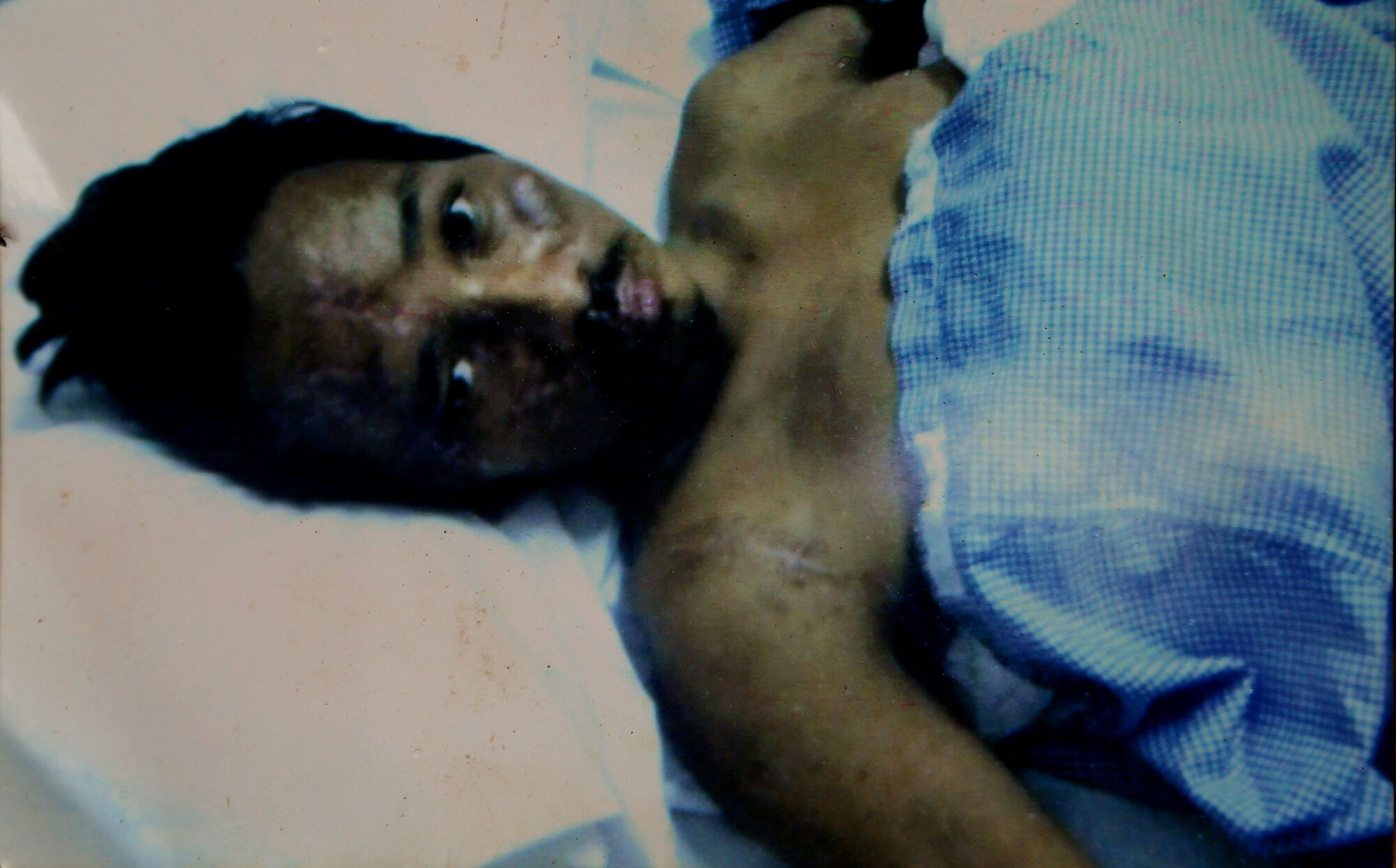 A man lies in a hospital bed under a blue sheet