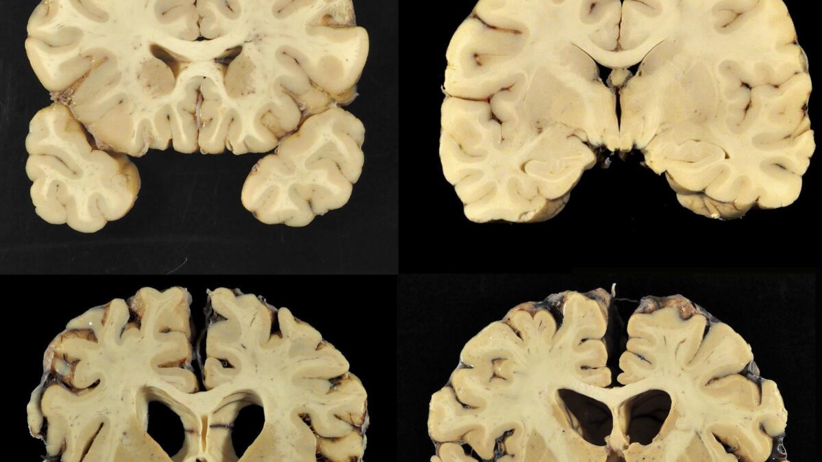Photos provided by Boston University shows sections from a normal brain, top, and from the brain of former University of Texas football player Greg Ploetz, bottom, in stage IV of chronic traumatic encephalopathy.