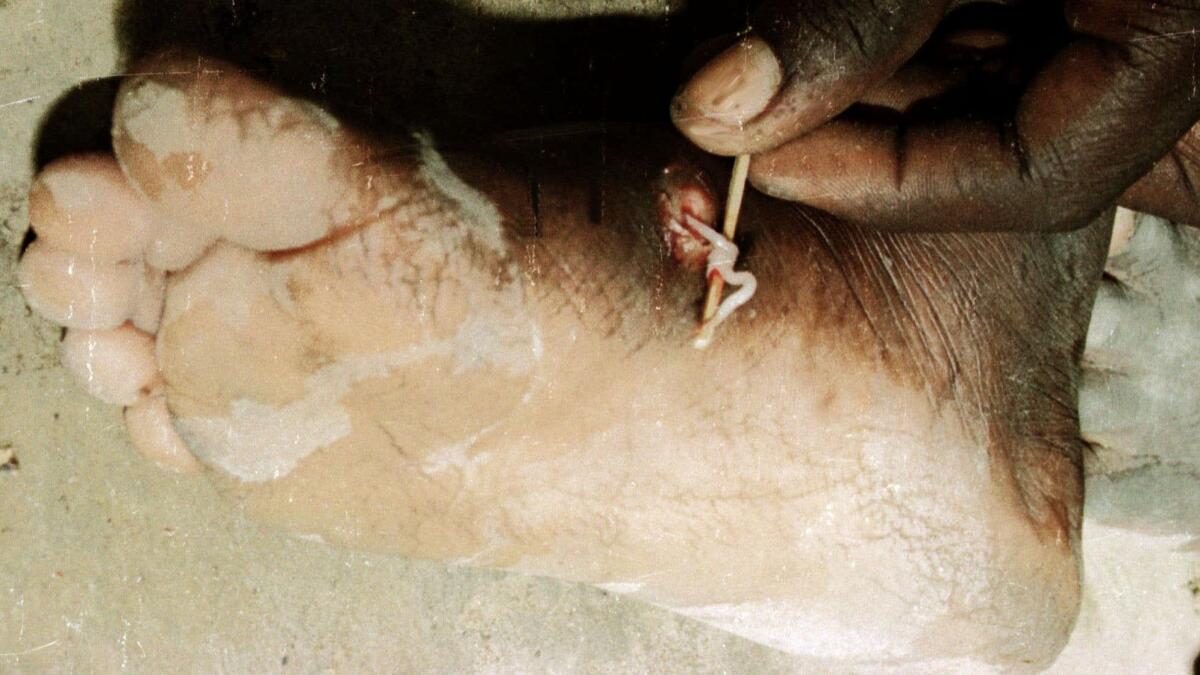 In this 2001 photo, a volunteer pulls a Guinea worm out of the foot of a patient in the Alek region of then southern Sudan.