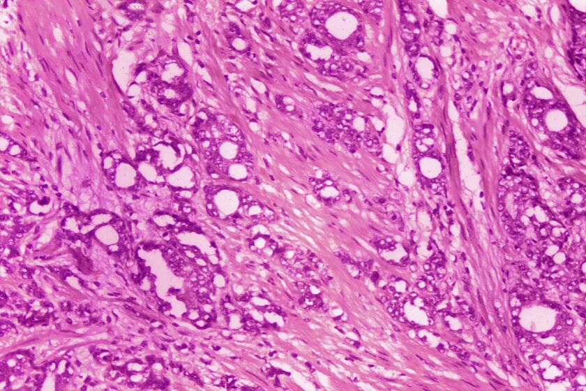 ARCHIVO - Esta imagen tomada con microscopio y facilitada por los Centros para el Control y la Prevención de las Enfermedades muestra cambios en las células, en un indicio de adenocarcinoma en una próstata. (Dr. Edwin P. Ewing, Jr./CDC vía AP)