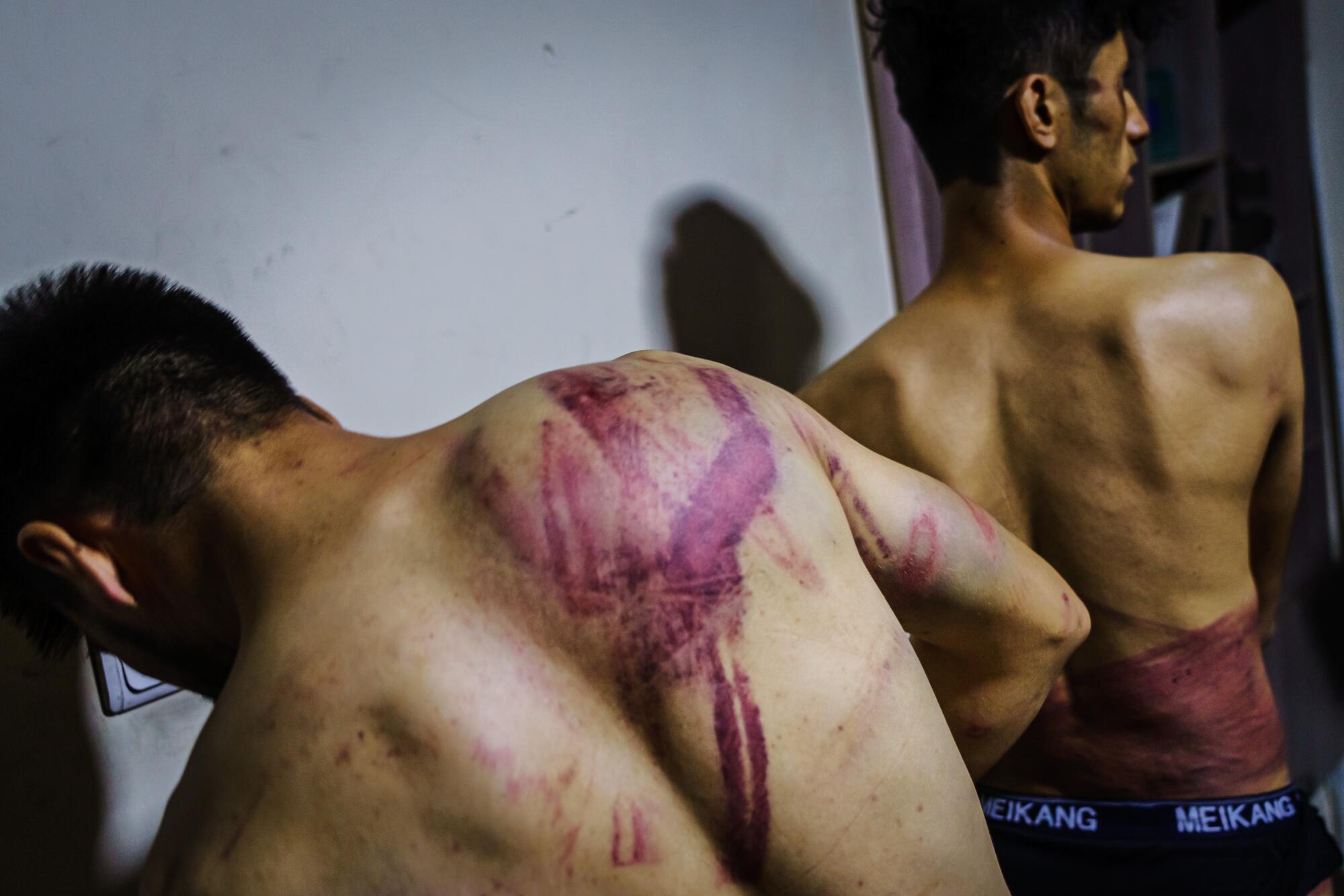 Journalists from the Etilaat Roz newspaper show purple wounds on their backs