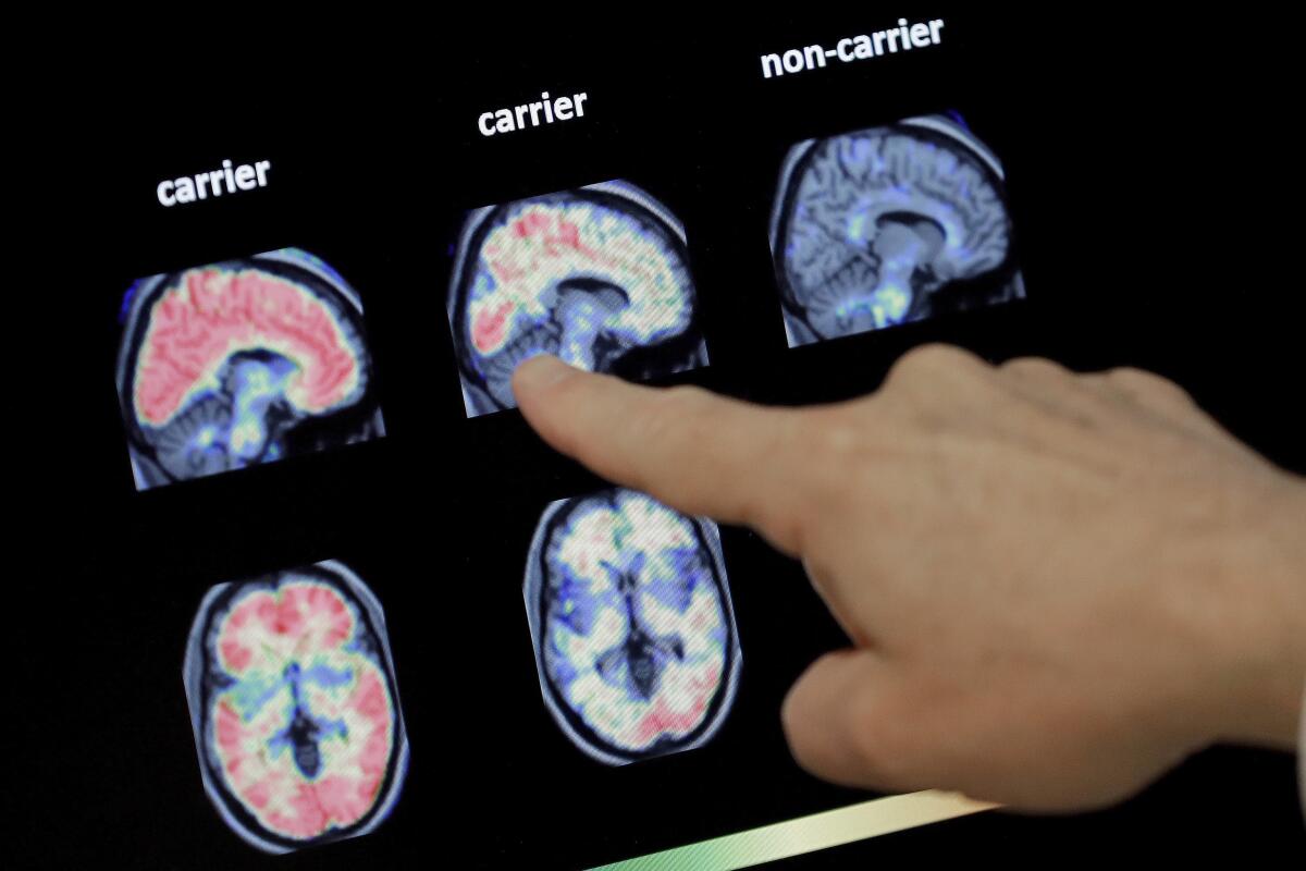A hand points to a screen with images from a brain scan.