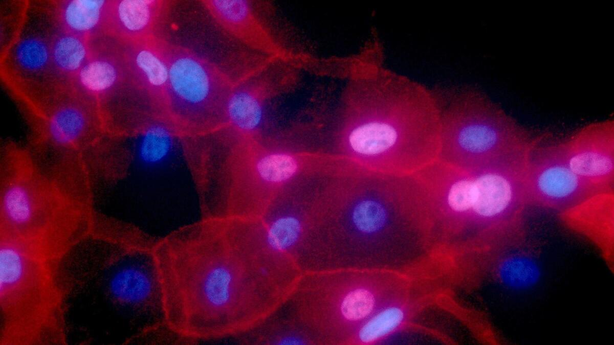 A culture of human breast cancer cells, prepared by the National Institutes of Health.