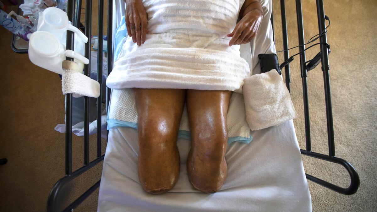 Californian woman had all limbs amputated and 'almost lost her