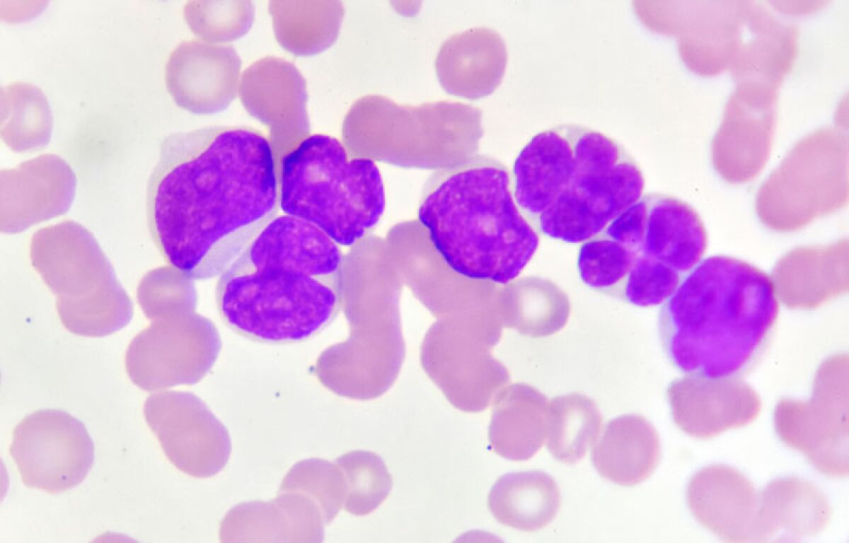 Acute myeloid leukemia cancer cells are viewed under a microscope.