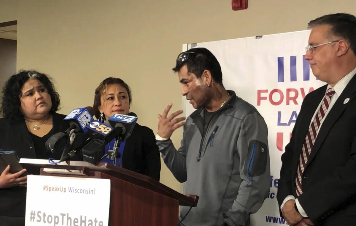 Mahud Villalaz, 42, of Milwaukee shows the second-degree burns on his face on Saturday at a news conference one day after a man threw acid at him outside a restaurant on Milwaukee's south side. He is joined by, from left, state Rep. JoCasta Zamarripa; his sister, Priscilla Villalaz; and Forward Latino leader Darryl Morin.