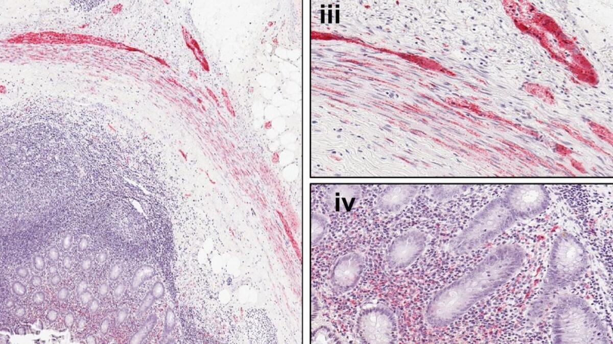 Los apéndices saludables contienen alfa-sinucleína (que se muestra en rojo), una proteína que es un componente de los cuerpos de Lewy observados en la enfermedad de Parkinson.