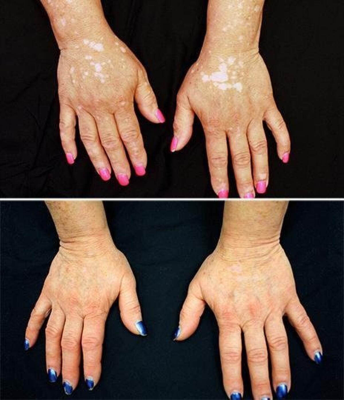 michael jackson vitiligo before and after